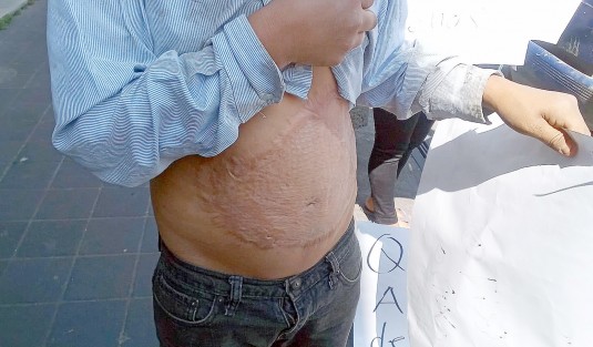 Martín Vargas Morales y su familia viajaron desde la comunidad de Cetlalpan, municipio de Ayahualulco, para pedir ayuda al Gobierno del Estado, debido a que su hijo menor resultó con quemaduras de tercer grado ocasionadas por la agresión con gasolina por parte de una persona alcohólica, la cual hasta el momento no ha respondido por el daño. 
