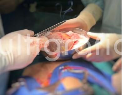 Unos 800 veracruzanos en espera de un riñón y 80, por una córnea